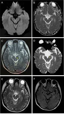 Case report: Anti-NMDA receptor encephalitis manifesting as rapid weight loss and abnormal movement disorders with alternating unilateral ptosis and contralateral limb tremor